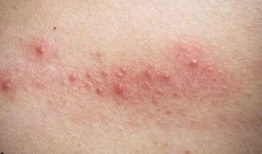 吃瓜对湿疹有影响,揭秘饮食对湿疹的影响