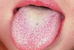 吃瓜吃了舌头出血,吃瓜过度致舌头出血的警示