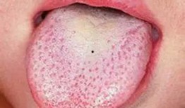 吃瓜吃了舌头出血,吃瓜过度致舌头出血的警示